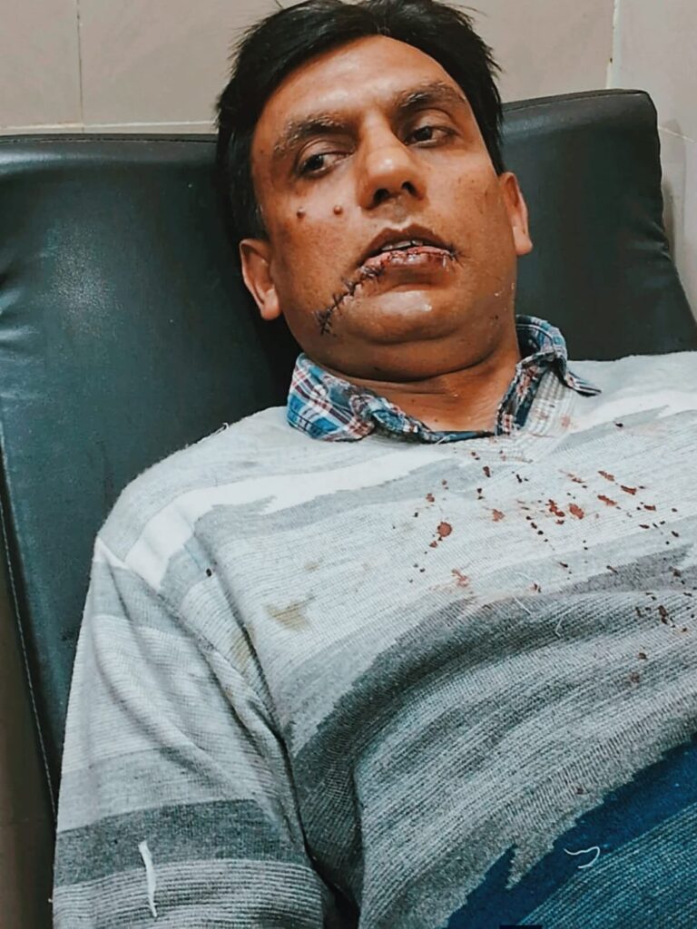 लखनऊ में फिर मौत का मांझा ! गोमतीनगर विस्तार में रिटायर्ड फौजी का जबड़ा